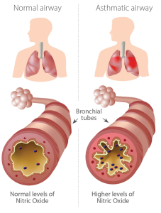 Asthma & FeNO Explained | Bedfont NObreath® FeNO Monitor